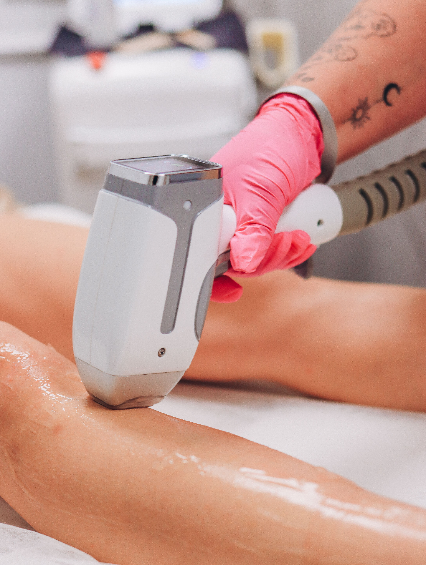 Sessão de depilação a laser nas pernas