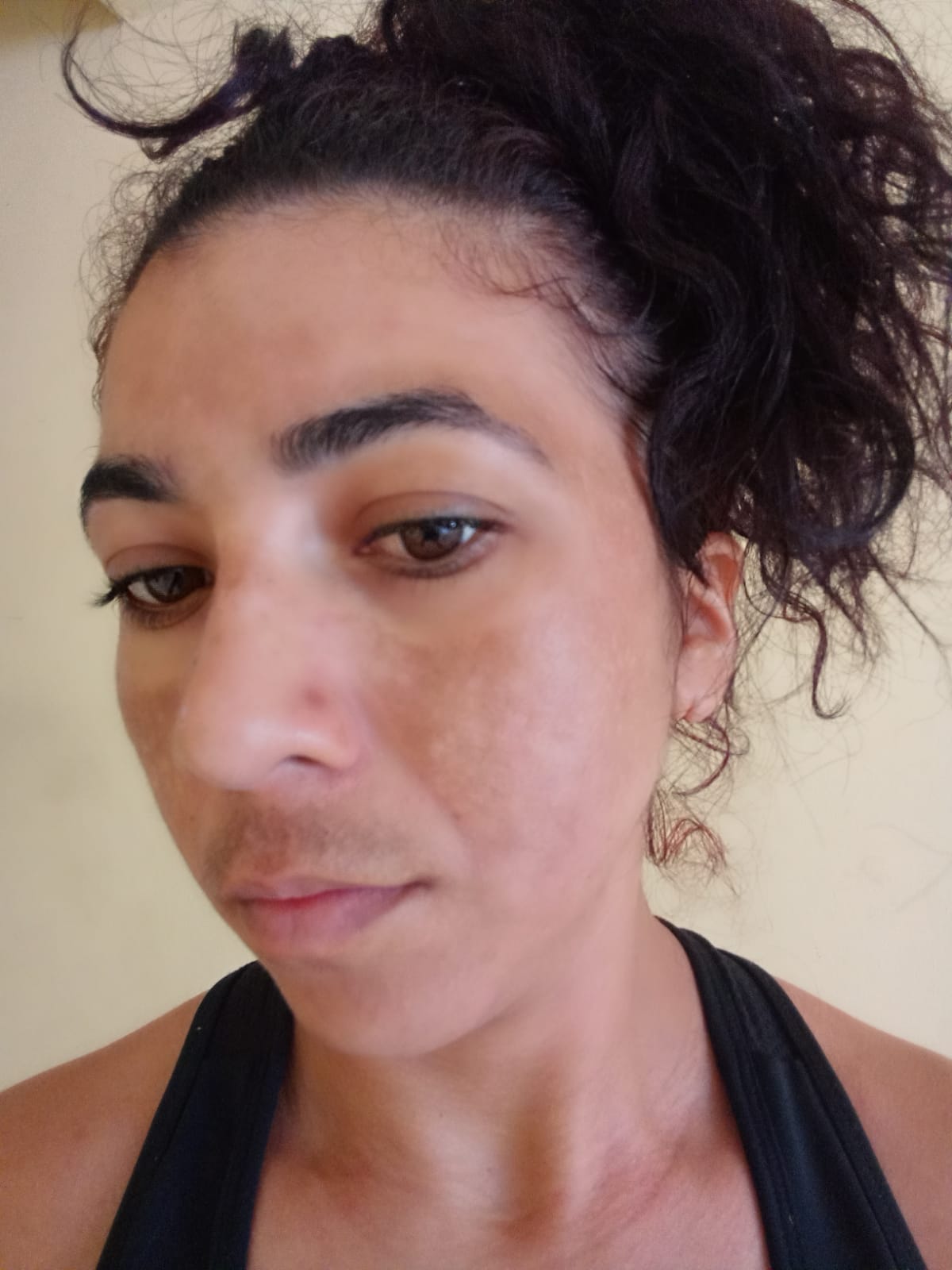 Depois – Peeling de Renovação Facial