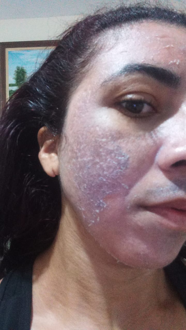 Antes – Peeling de Renovação Facial