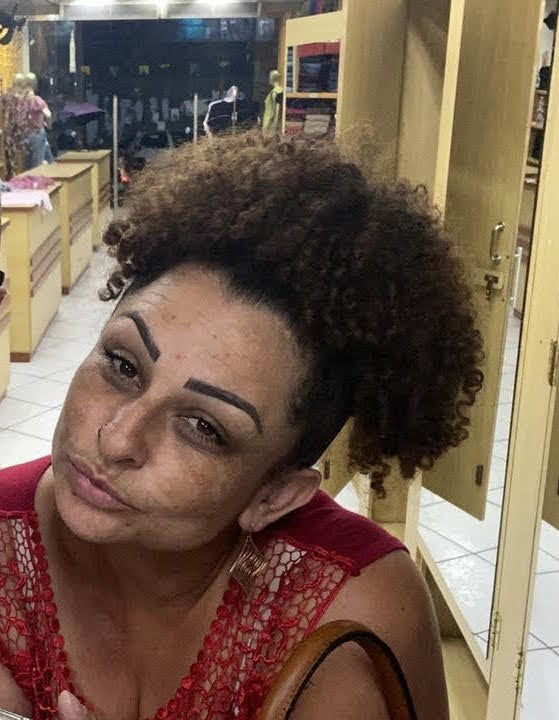 Antes – Peeling para Manchas e Melasma